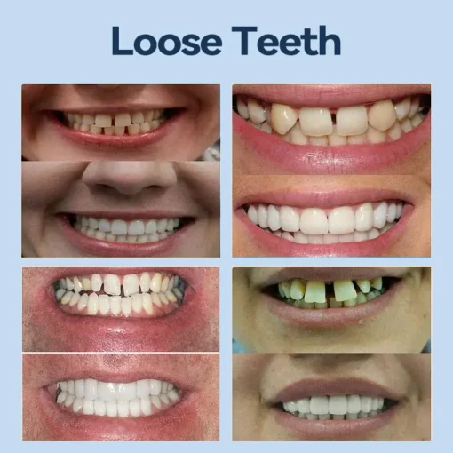 SmileFitPro® – 𝐌𝐞𝐝𝐢𝐜𝐚𝐥𝐅𝐢𝐭 𝐀𝐝𝐚𝐩𝐭𝐢𝐯𝐞 𝐃𝐞𝐧𝐭𝐮𝐫𝐞𝐬
