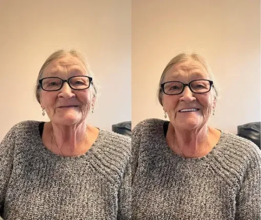 SmileFitPro® BioFusion Dentures