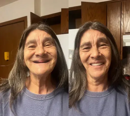 SmileFitPro® BioFusion Dentures