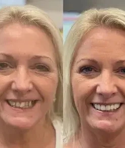 SmileFitPro® BioFusion Dentures