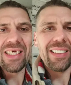 SmileFitPro® BioFusion Dentures