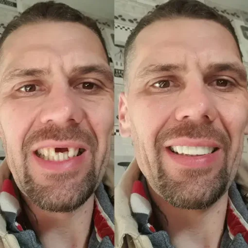 SmileFitPro® BioFusion Dentures