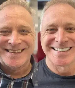 SmileFitPro® BioFusion Dentures