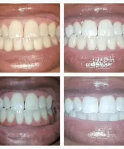 SmileFitPro™ Extra-Strength Teeth Whitening Serum Pen + Dual-Peroxide Formula & Xylitol