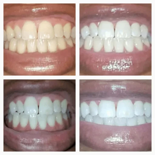 SmileFitPro™ Extra-Strength Teeth Whitening Serum Pen + Dual-Peroxide Formula & Xylitol
